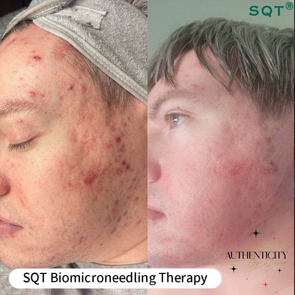 SQT Biomicroneedling Therapy In North York